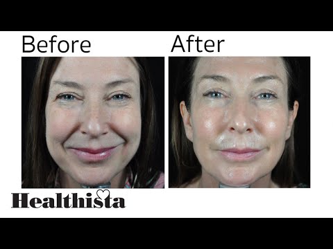 Profhilo treatment review - before and after pictures