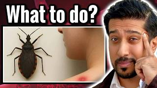 Famous The Kissing Bug Warning EVERYONE Should Know | Chagas Symptoms Net Worth