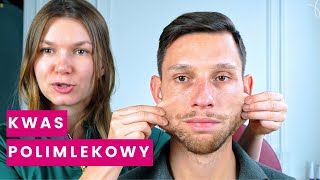 Kwas Polimlekowy – Zobacz Efekty Po 3 Miesiącach + ZABIEG | Stymulator Tkankowy- Medycyna Estetyczna