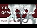 X-Ray Sequence Of Perthes Disease