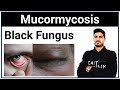 Mucormycosis | Black fungus | Black fungus link with COVID-19