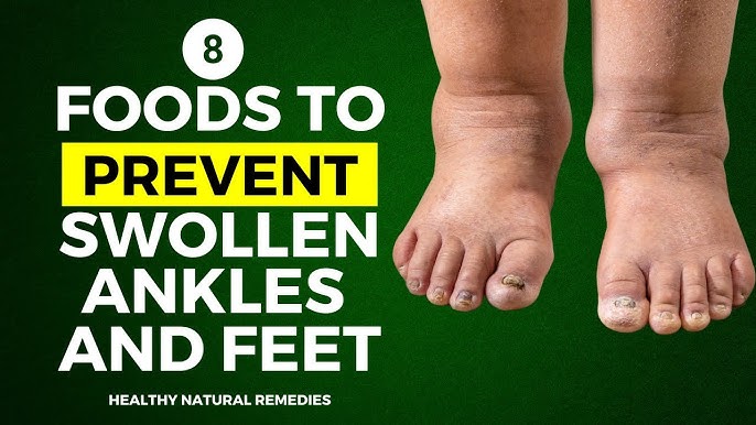 15 Years of Swollen Legs & Feet Gone in Minutes! Barbara O'Neill's HIDDEN  Discovery - YouTube