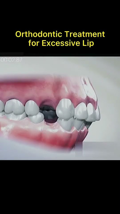 Orthodontic Treatment for Lip Protrusion #Orthodontic #LipProtrusion #DentalCare #Orthodontics