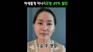 미세 수술 리프팅 49% 할인 #노화방지시술 #리프팅효과 #리프팅효과 #동안비결