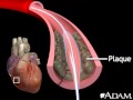 Balloon angioplasty