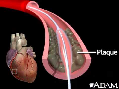 Balloon angioplasty