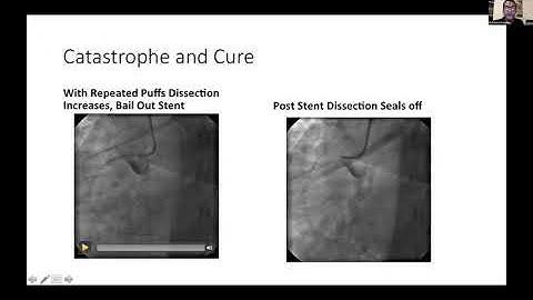 CTO Complications: How Should We Tackle?