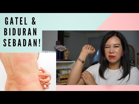 Cara Mengatasi Biduran & Gatal-Gatal (Urticaria) + Giveaway!