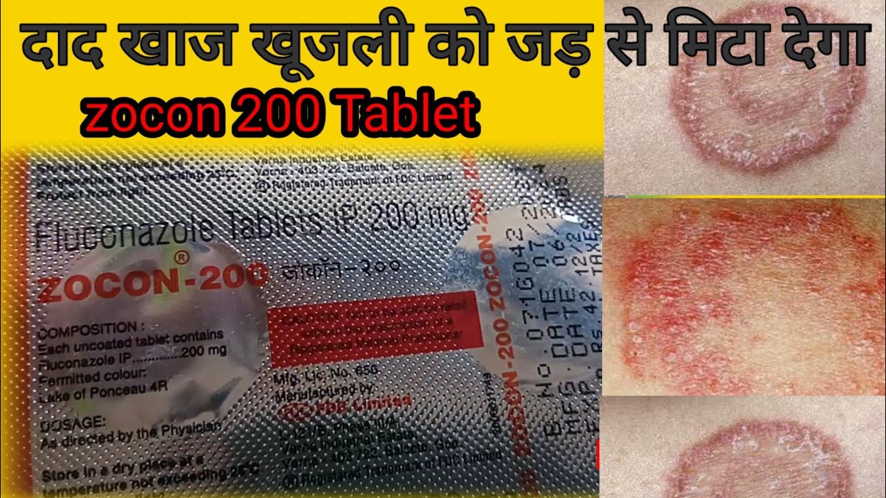 Zocon 200 Tablet, Fluconazole 200mg Tablet, Zocon Tablet Use In Hindi