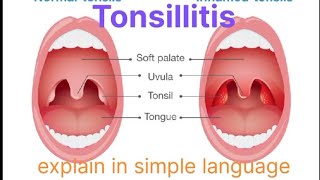 Tonsillitis explain in hindi #medical #tonsillitis #trending #viral #video 
