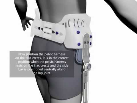 coxa valga etiología de la diabetes coxa valga etiología de la diabetes