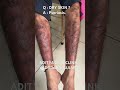 Psoriasis is not just dry skin — it’s an autoimmune condition.