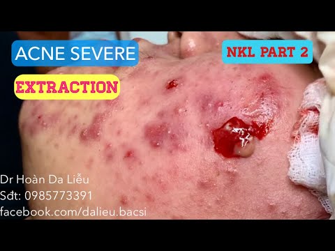 Mụn trứng cá mủ viêm cực nặng|Dermatologist,pimples,whitehead,acne severe extraction NKL part 2