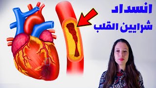 علاج انسداد شرايين القلب بدون جراحة