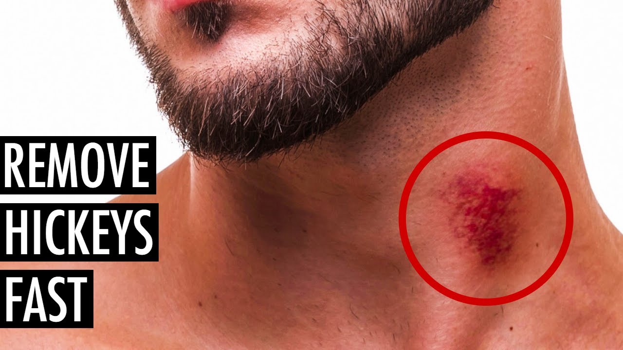 What Can Cause Hickey Like Marks