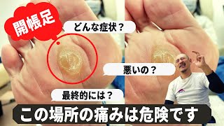 開帳足の治し方でまずこれだけは知ってください！【外反母趾・足の痛み改善 バイタルTV】