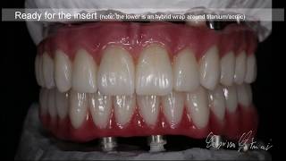 Zirconia Monolithic Full Implant Bridge Tutorial