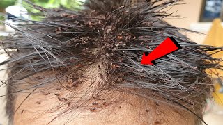 Remove big lice on boy head - Lice combing