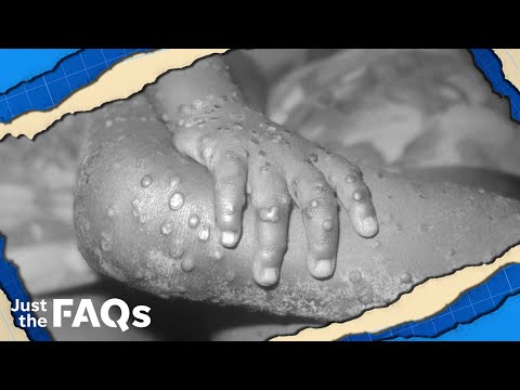 Here's why we shouldn't be too concerned about monkeypox | JUST THE FAQS