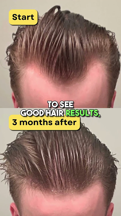 Microneedling your scalp to regrow hair