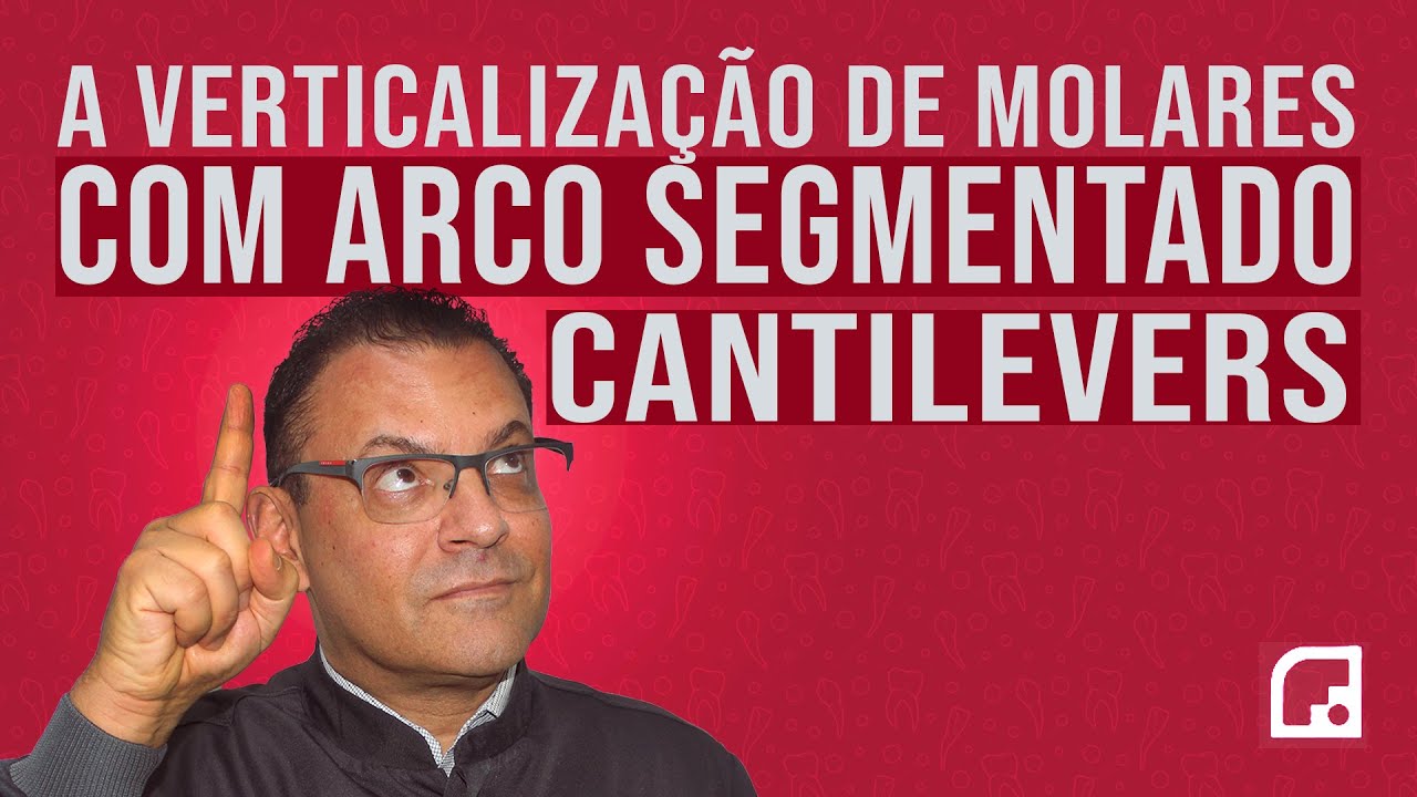 VERTICALIZAÇÃO DE MOLARES COM ARCO SEGMENTADO - CANTILEVERES | FERNANDO MANHÃES