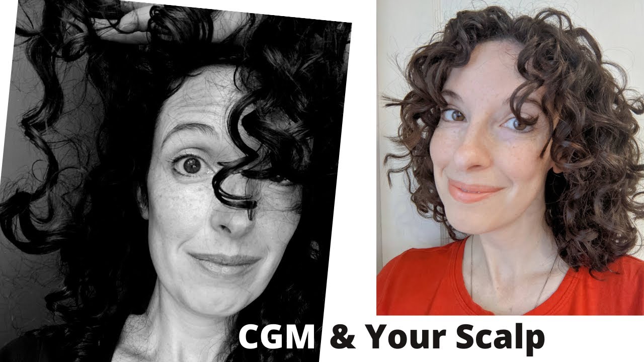 Can You Follow the Curly Girl Method with Seborrheic Dermatitis? Fix ...