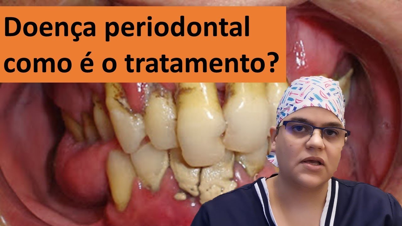 Tratamento De Doenca Periodontal Doença Periodontal Associada à