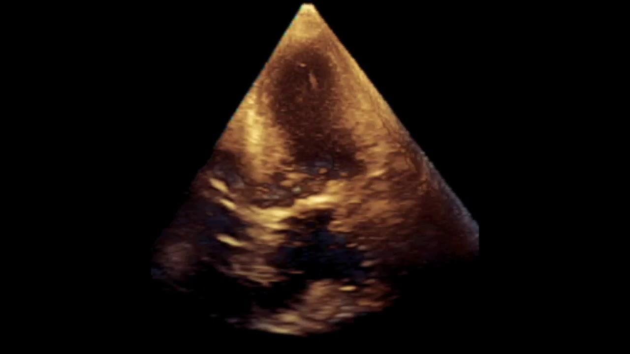 A 103 year old Woman: Aortic Stenosis video editing software free