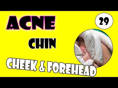 Cystic Acne Treatment Jully  - Removal Acne On Chin, Cheek And Forehead On Man Face