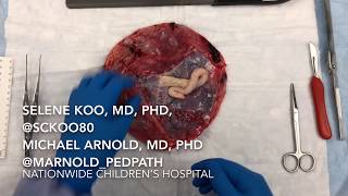 Grossing a placenta in 90 seconds #GrossIn90 #NCHpath