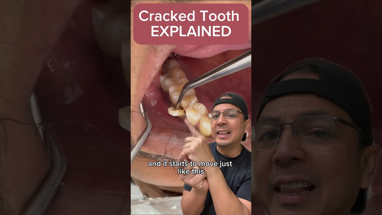 What to Do if You Have a Cracked Tooth | View Mobile Dental #shorts