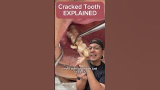What to Do if You Have a Cracked Tooth | View Mobile Dental #shorts