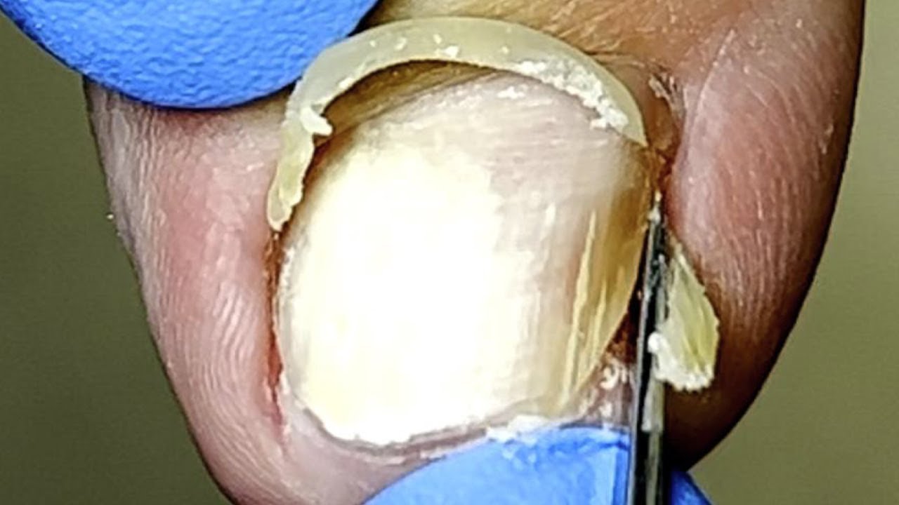 Large Patches Of White Impurities On Toenails Xue Yidao Pedicure YouTube Large patches of white impurities on toenails xue yidao pedicure youtube