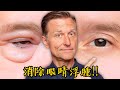 眼睛浮腫、眼皮腫怎麼辦？(2024年新影片),自然療法,柏格醫生 Dr Berg