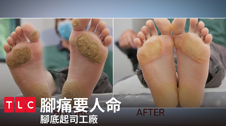 《腳痛要人命》腳底硬到可以剉起司？請各位觀眾切勿在家自行動手術｜TLC 旅遊生活頻道 - 天天要聞