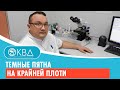 🙁 Темные пятна на крайней плоти. Клинический случай №502