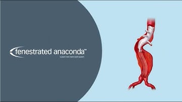 Anaconda Fenestrated Animation - Terumo Aortic