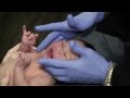 Lip Tongue Tie Frenectomy Exercises