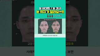 눈 비대칭, 눈 경사? 눈 위치가 달라요!! #눈비대칭