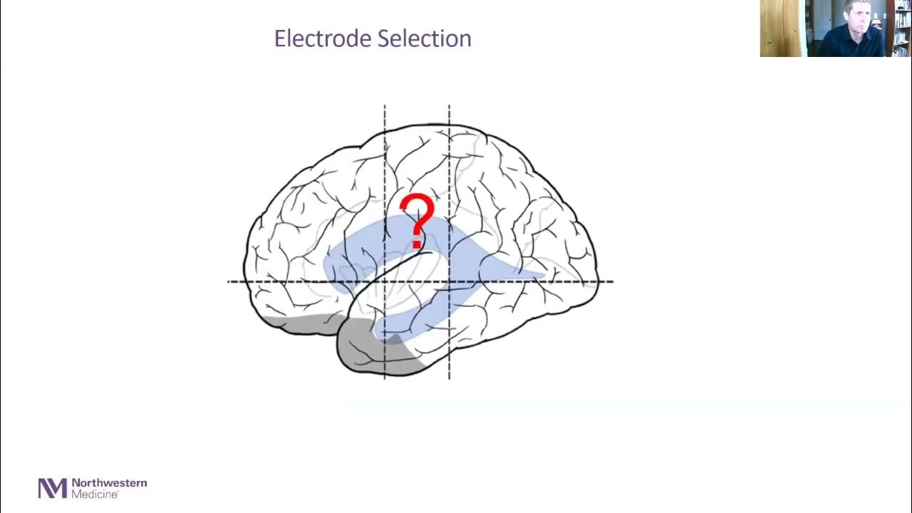 Invasive EEG Monitoring in Epilepsy YouTube