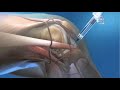 Top Knee Problems in Primary Care - Brian Feeley, MD