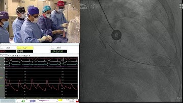 SAPIEN 3 TAVR - Live Case 1