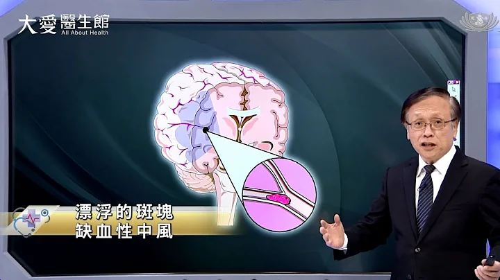【大爱医生馆】漂浮的斑块~缺血性中风 20230704 - 天天要闻