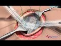 Ucmc clearmesh composite  umbilical hernia repair