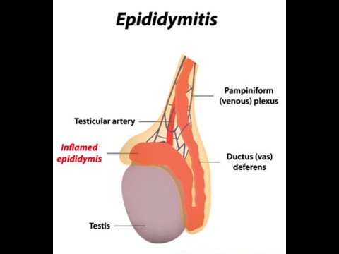 How To Get Rid Of Epididymitis Naturally How To Get Rid Of Epididymitis Naturally