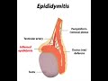 Epididymitis