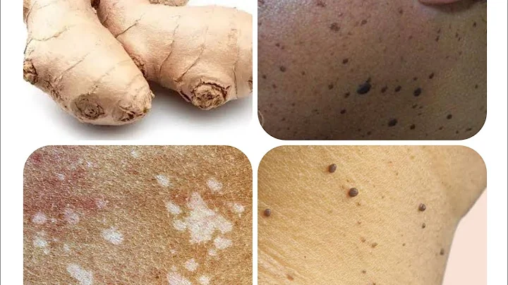 how to remove your skin tags and white patches nat...