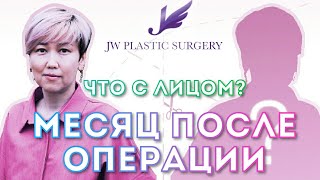 МЕСЯЦ ПОСЛЕ ОПЕРАЦИИ: что с лицом?? JW Plastic Surgery