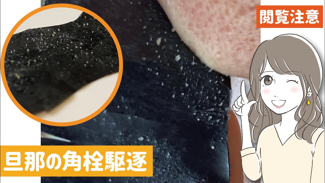 毛穴パックで頬の角栓を駆除 Youtube 毛穴パックで頬の角栓を駆除 Youtube