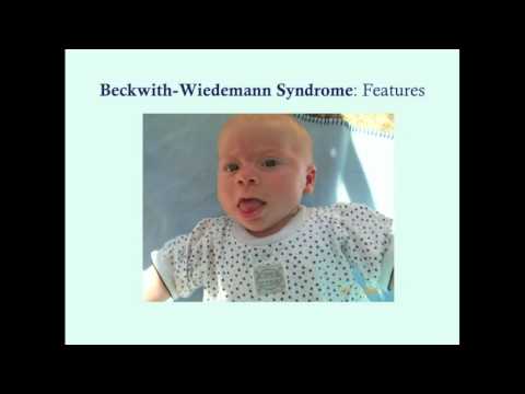 Video: Was sind die Symptome des Beckwith-Wiedemann-Syndroms?